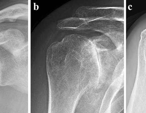 Spalla normale, artrosi gleno-omerale concentrica, artrosi gleno-omerale eccentrica 1