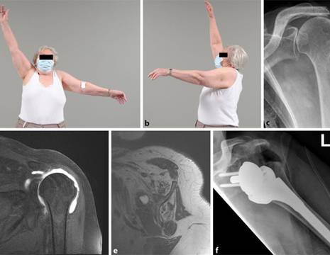 Spalla pseudoparalitica con risalita epifisi omerale e degenerazione adiposa muscolare. Intervento risolutivo di protesi inversa spalla 1