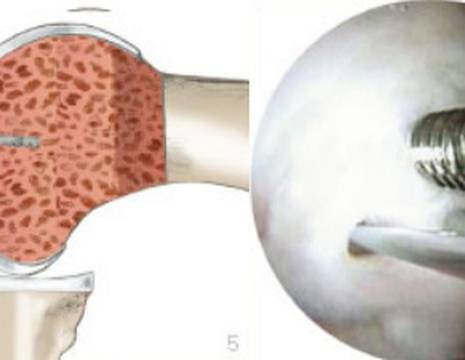 Stabilizzazione frammento osteocartilagineo ginocchio 1