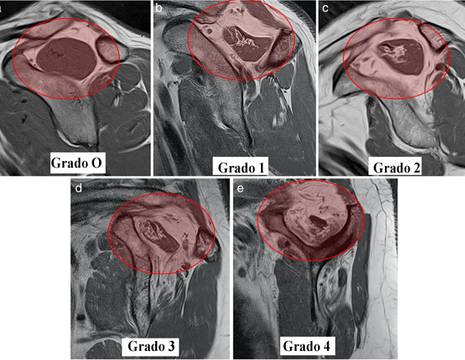 Stato muscolare nelle lesioni della cuffia dei rotatori. Solitamente il grado 3 e 4 è associato a lesioni non riparabili della cuffia rotatori 1