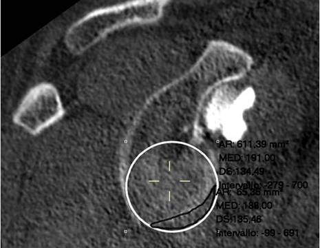 TC spalla prima dell'intervento, per valutare il deficit osseo 1