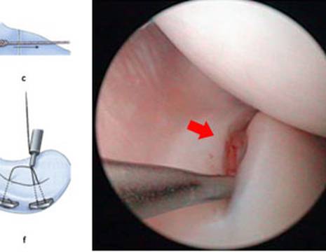 Tecnica di sutura all_inside con fili attaccati ad ancore. Lesione del menisco ed aspetto dopo la riparazione 1