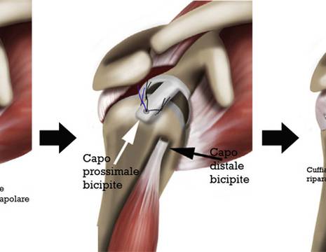 Tecnica moderna di ricostruzione capsulare con tendine bicipite alla spalla 1