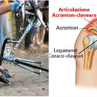 Lussazione articolazione acromion claveare