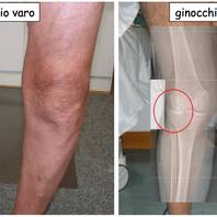 Ginocchio varo e ginocchio valgo: sintomi, cause, terapie e intervento chirurgico