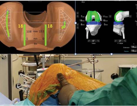 Utilizzo_della_navigazione_durante_intervento_di_protesi_al_ginocchio.jpg 1