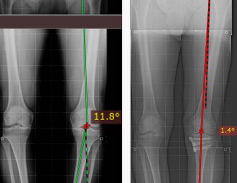 Valerio. Prima e dopo intervento di osteotomia ginocchio SINISTRO 1