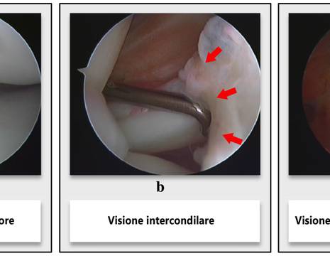 Visualizzazione in artroscopia di lesione radice meniscale. Visione standard (a) e con tecnica e portale accessorio (b,c) 1