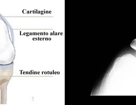 Aspetto clinico e radiografico normale dell'articolazione femoro-rotulea.jpg 1