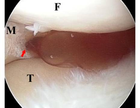 Visione in artroscopia. Fuoriuscita di materiale gelatinoso di una cisti attraverso lesione del menisco (freccia). M menisco, T tibia, F femore 1