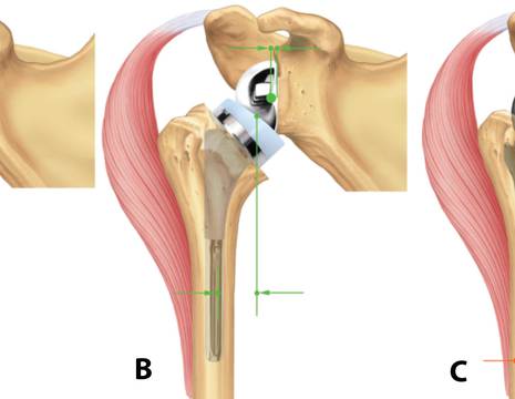 (A) Protesi inversa INSET originale di Grammont. (B) Protesi inversa INSET con omero lateralizzato. (C) Protesi inversa con glenoide lateralizzata 1