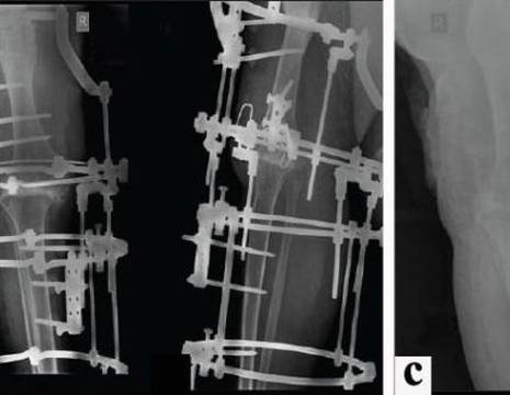 Grave infezione di protesi di ginocchio trattata con artrodesi di ginocchio con fissatore esterno 1