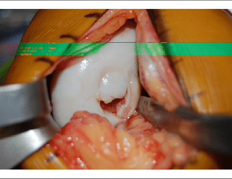 Foto intraoperatoria di un ragazzo 13 anni con osteocondrite dissecante al ginocchio 1