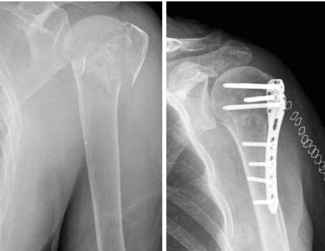 frattura omero prossimale di spalla trattata con placca e viti 1