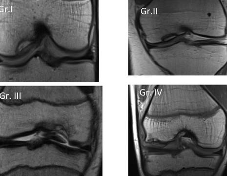 ​I 4 gradi di osteocondrite rilevati dalla risonanza magnetica 1