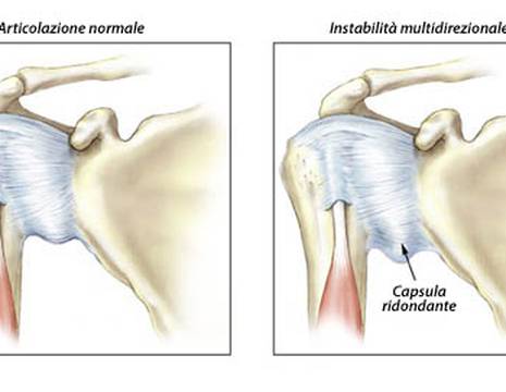 Instabilità multidirezionale di spalla 1