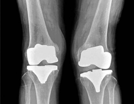 Instabilità protesi di ginocchio, da notare a destra l'apertura dello spazio interno 1