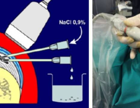 Schema procedura di lavaggio in ecografia di calcificazione spalla 1