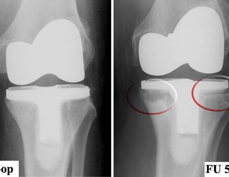 A sinistra Rx dopo un intervento di protesi totale di ginocchio, a destra osteolisi con mobilizzazione della protesi di ginocchio 2