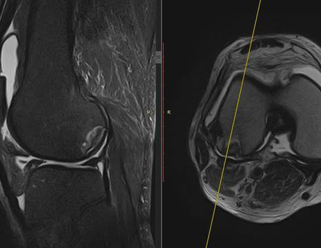 Osteocondrite degenerativa in uomo di 65 anni 1