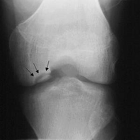 Osteocondrite al ginocchio