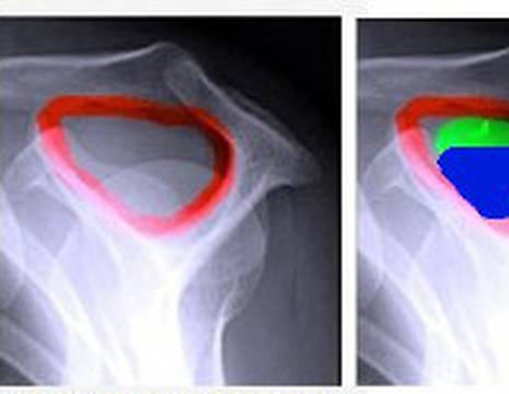 Proiezione radiografica laterale della spalla -L’area in rosso corrisponde allo spazio subacromiale 1