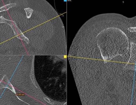 planning TC preoperatorio 1