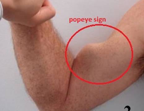 popeye sign da rottura del tendine bicipite alla spalla.jpg 1