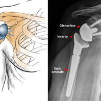Protesi di spalla INVERSA: cos’è, come funziona, risultati, complicanze