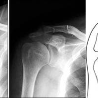 Acromion claveare: intervento di ricostruzione dell'articolazione