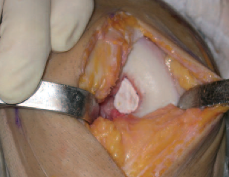 scaffold per lesione osteocondrale estesa al femore 1