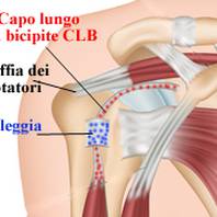 Lesioni del tendine capo lungo del bicipite