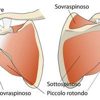 Lesione cuffia dei rotatori: cause e sintomi