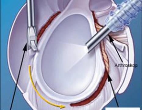 Schema intervento di artrolisi artroscopica di spalla 2