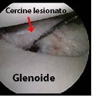 Protocollo riabilitativo dopo intervento di capsuloplastica in artroscopia