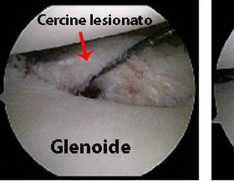 schema intervento capsuloplastica o riparazione cercine della spalla 1