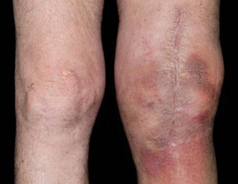 Sospetta infezione protesi al ginocchio 1