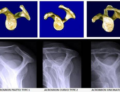 Diverse tipologie di acromion secondo Bigliani 1