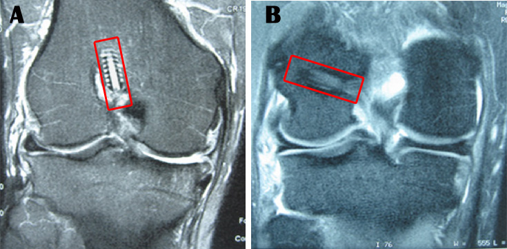 A. Erroneo posizionamento verticale del tunnel al femore. B. Corretta posizione anatomica del tunnel.jpg