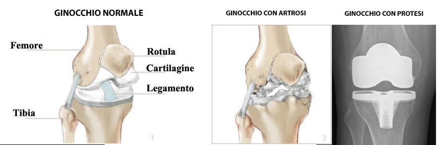 Anatomia ginocchio normale, con artrosi, con protesi