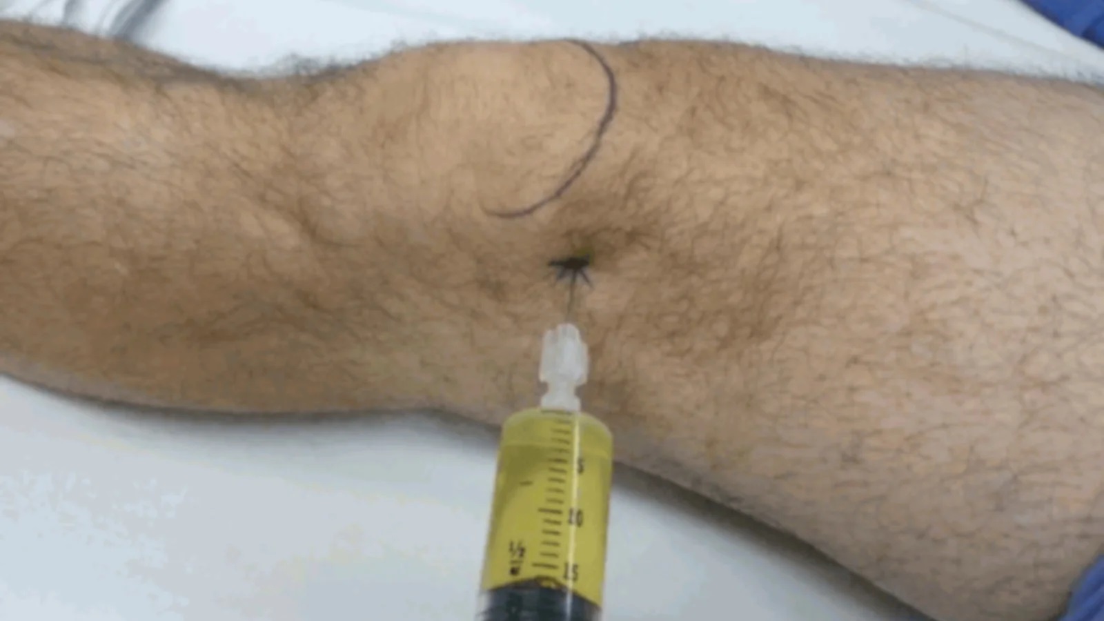 C:\fakepath\Aspirazione di liquido per gonfiore al ginocchio.jpg