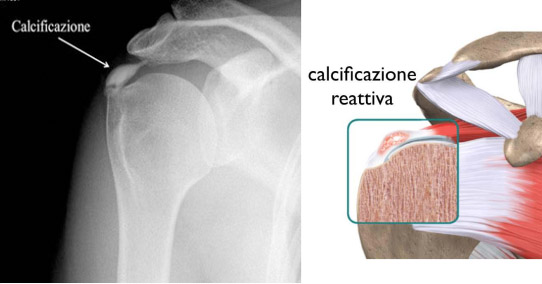 Calcificazione di spalla. Radiografia e schema della patologia