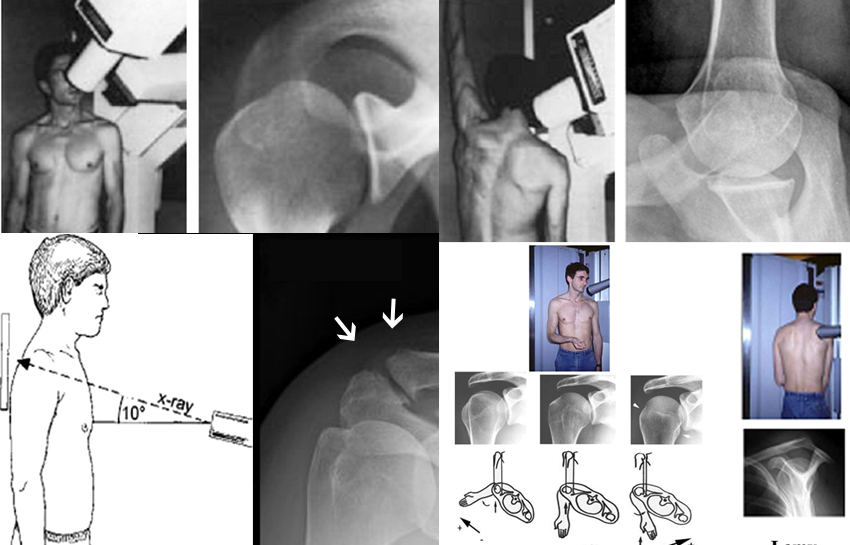 Diverse tipologie radiografie di spalla