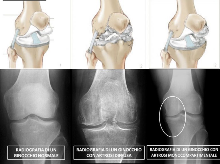 GINOCCHIO NORMALE E CON ARTROSI