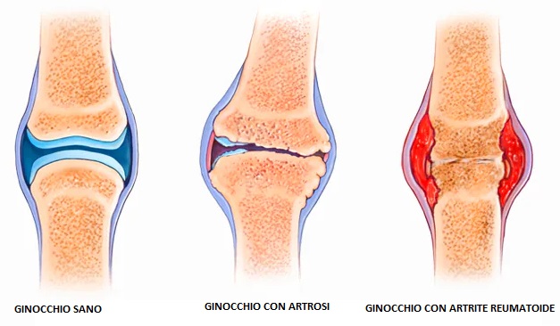 Ginocchio sano, con artrosi e con artrite reumatoide