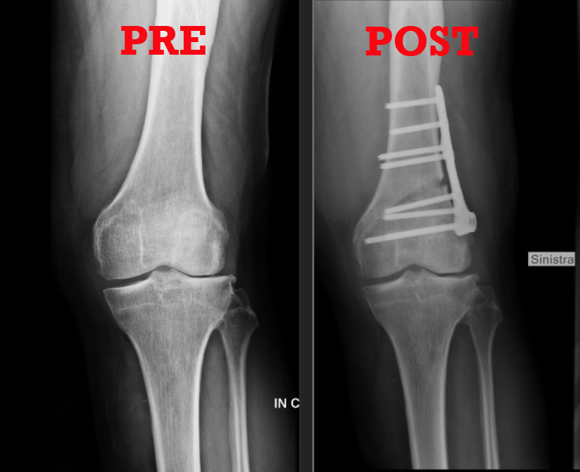 C:\fakepath\Intervento osteotomia femorale varizzante.jpg