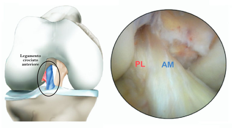 Legamento crociato anteriore con i suoi 2 fasci (AM antero-mediale, PL postero-laterale)