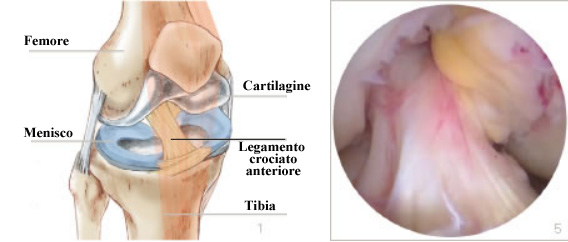 Aspetto anatomico e visione artroscopica di legamento crociato anteriore intatto