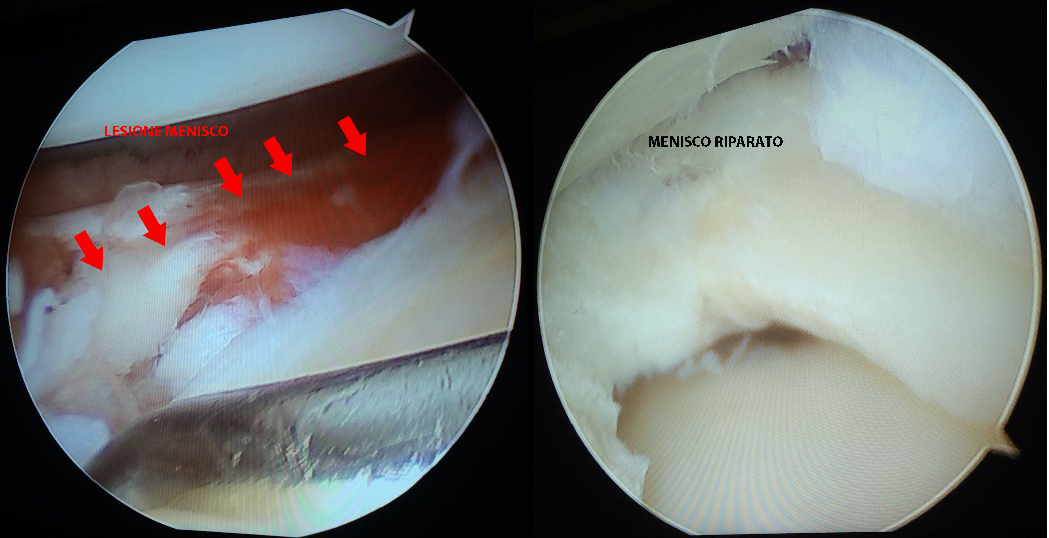Paolo, lesione menisco esterno riparata in artroscopia