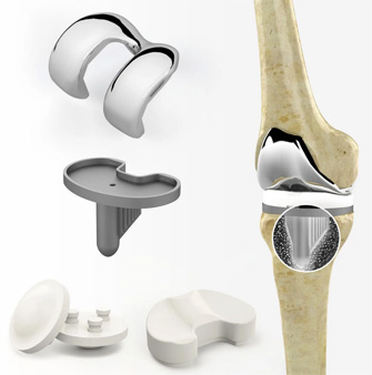 Materiali di una protesi al ginocchio